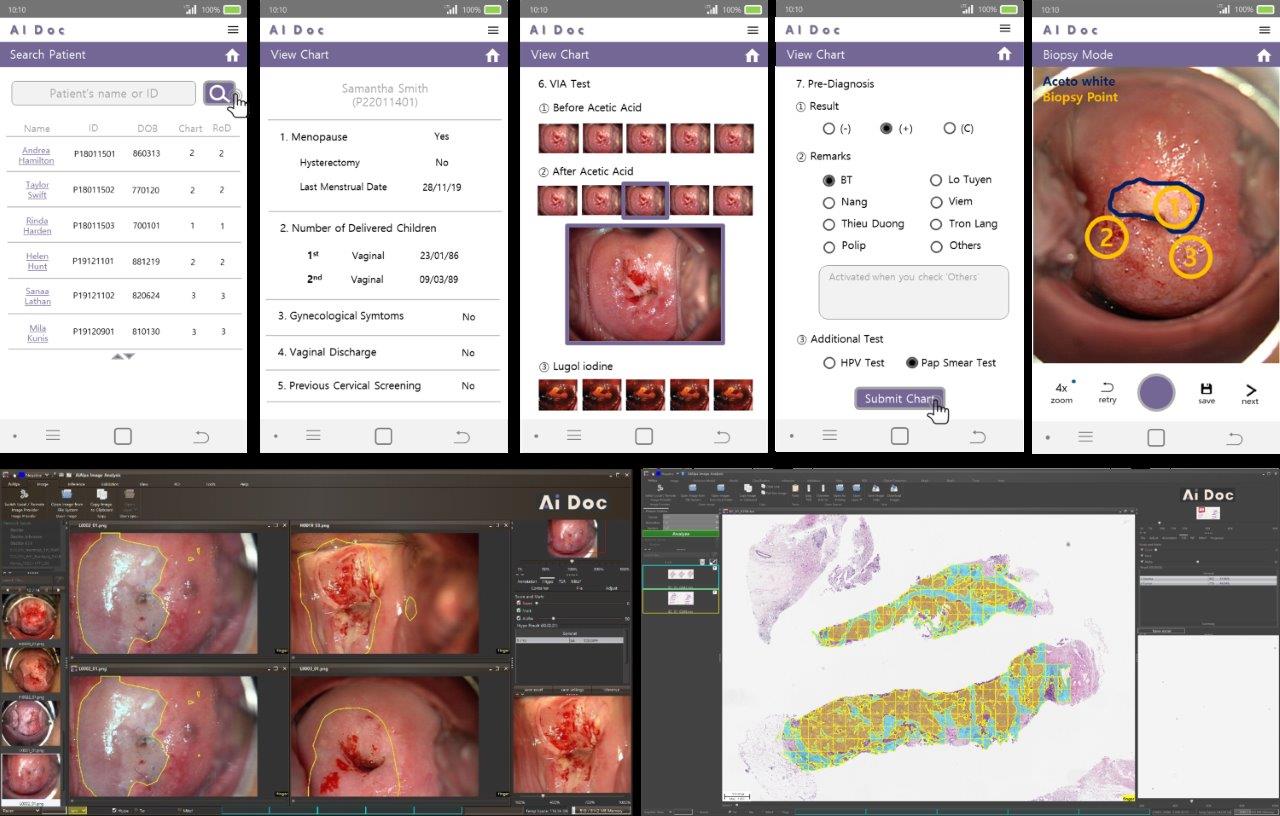 AI Doc : AI Diagnosis and Prediction Platform for Female Cancer